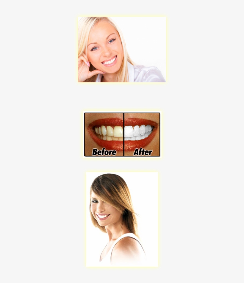Teeth Whitening Is Perhaps The Most Common Cosmetic - Isme Rasyan Herbal Clove Toothpaste Natural Whitening, transparent png #3978129