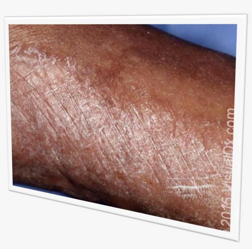 Foot Fungus - Bronze, transparent png #3986351