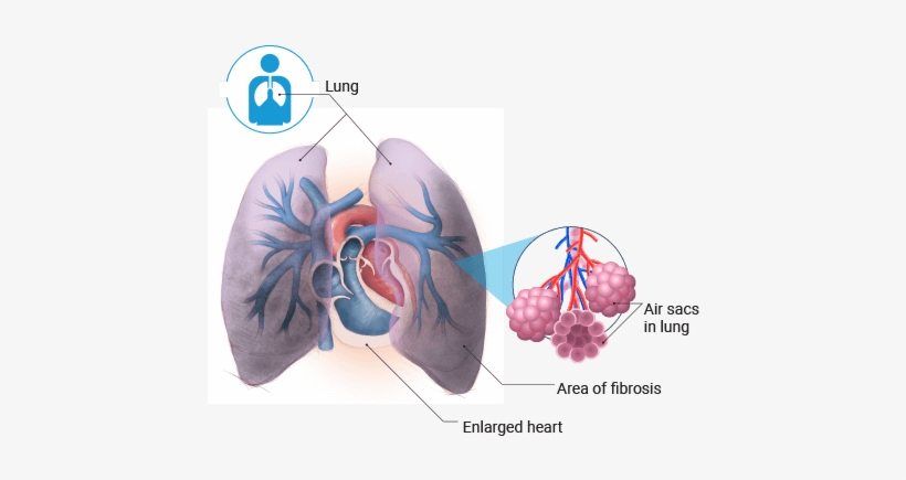 Idiopathic Pulmonary Fibrosis - Respiratory Care: Assessment And Management [book], transparent png #4017735