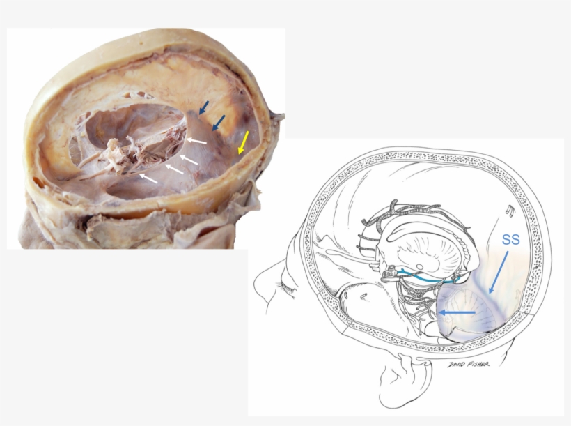 The Tentorial Incisura , - Cerebellar Tentorium, transparent png #4021494