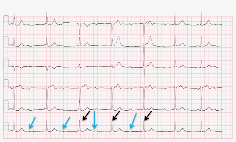 Conduction Ecg - Handwriting, transparent png #4040637