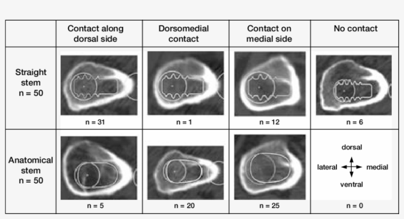 Location Of Contact Between The Internal Calcar Septum - Nasal Septum, transparent png #4061976