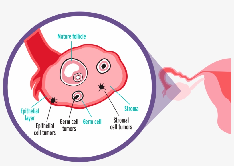 Epithelial Ovarian Carcinoma - Cell, transparent png #4080277