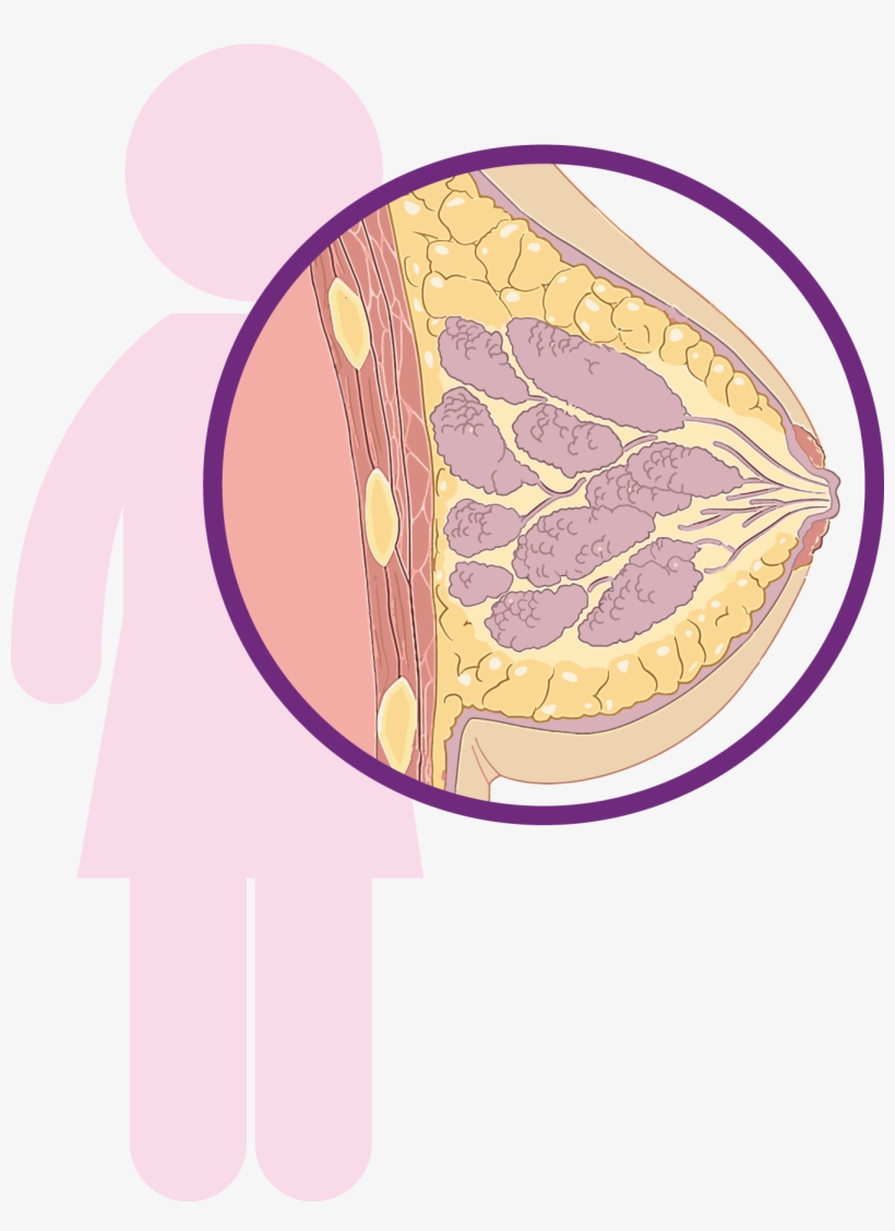 La Mayoría Son Carcinomas, Tipo De Cáncer Que Comienza - Breast Cancer, transparent png #4085001