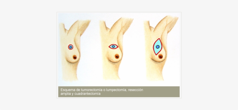Puede Ser La Mastectomía Simple , En La Cual Se Remueve - Radioterapia Neoadyuvante, transparent png #4086064