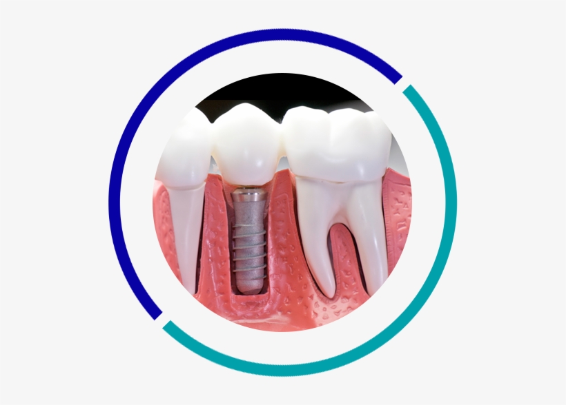 Dental Implants, transparent png #4092223