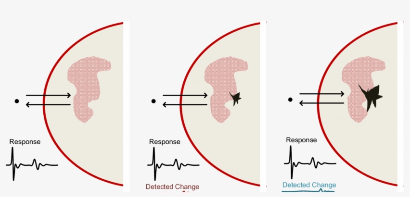 Llustration Of Three Breasts At Different Stages Which - Circle, transparent png #4096629