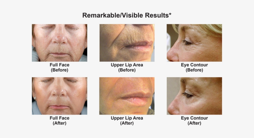 What Can Dot Co2 Therapy Do For Me - Collage, transparent png #4103026