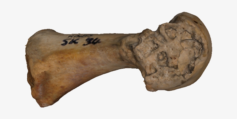 1st Metatarsal With Lesions Caused By Gout - Tool, transparent png #4106120