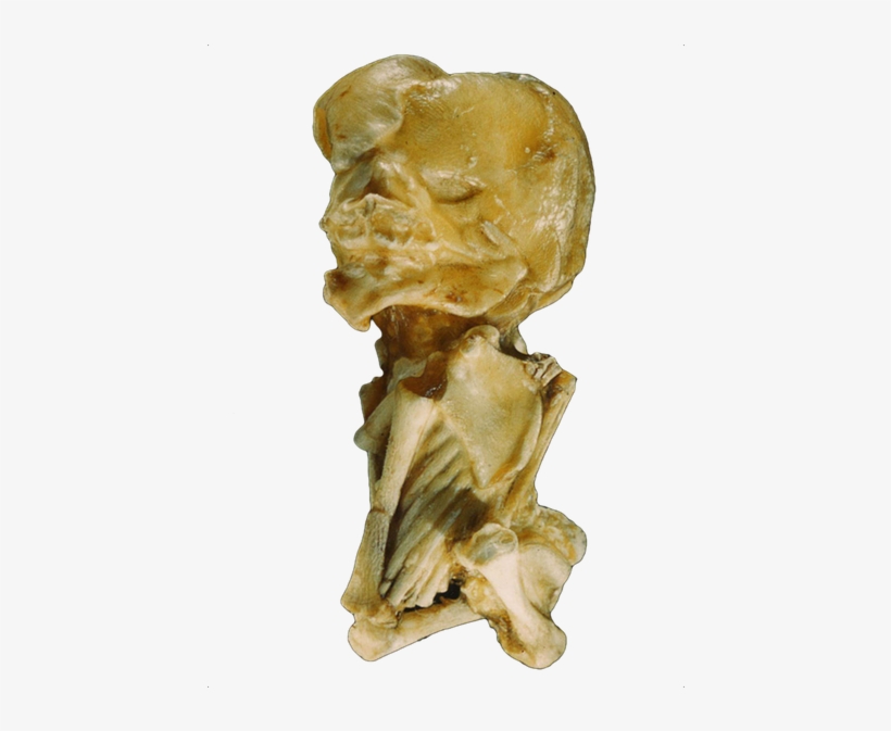 One Of The Best Qualities Of The People In The Trees - Lithopedion, transparent png #4107434