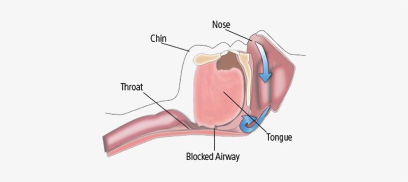 It May Be A Symptom Of A More Serious Sleep Disorder - Obstructive Sleep Apnea, transparent png #4109088