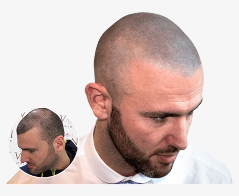 "i Love Having My Hair Back And Not Having To Use Hair-loss - Scalp Micropigmentation Filler, transparent png #4153606