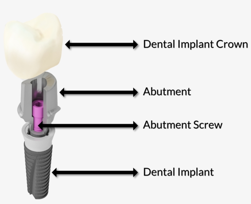 What Is The Difference Between A Dental Crown And A - Fixture Screw Abutment Crown, transparent png #4173918