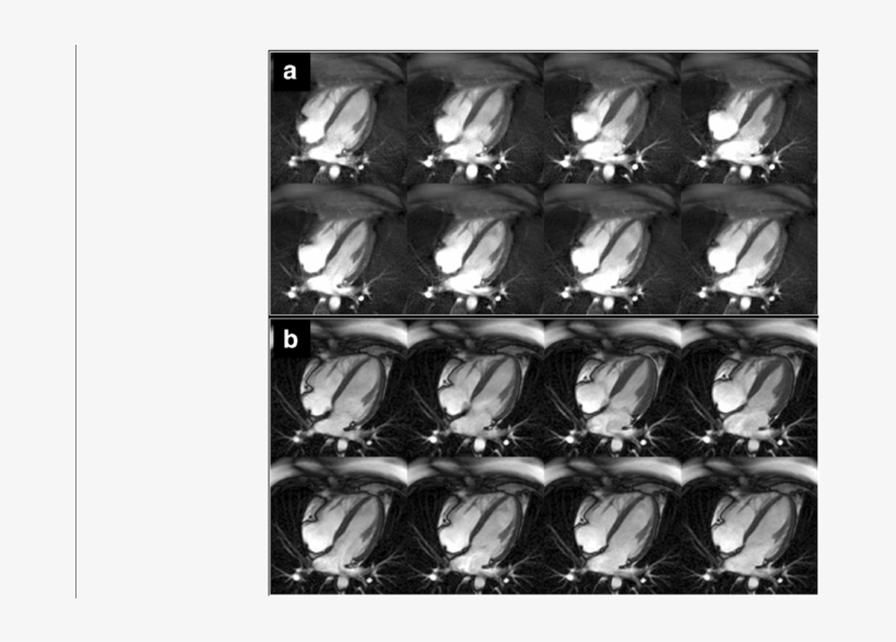 Comparison Of Four-chamber Cine Imaging Of The Heart - Fig.1, transparent png #4177711