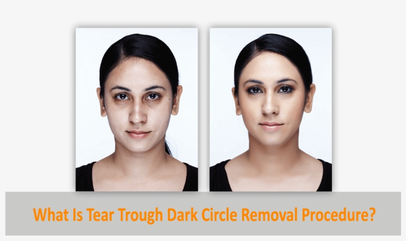 What Is Tear Trough Dark Circle Removal Procedure - Dark Circle Eye Roller Before And After, transparent png #4186715
