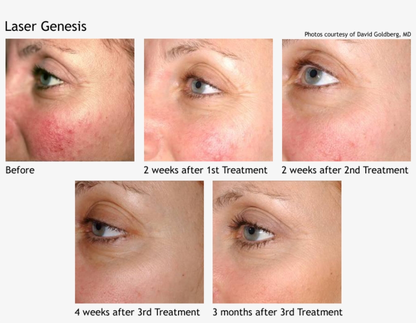 Laser Genesis Skin Therapy - Laser Genesis, transparent png #4277074