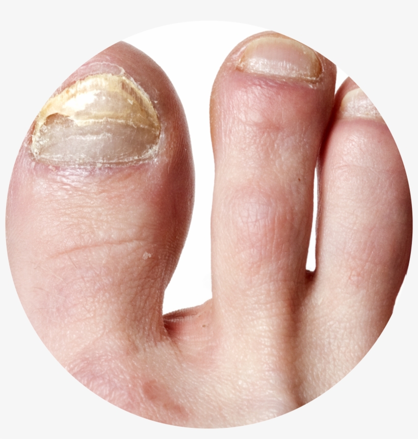Nail Infection Circle - Natural Way To Get Rid Of Toenail Fungus, transparent png #4319705