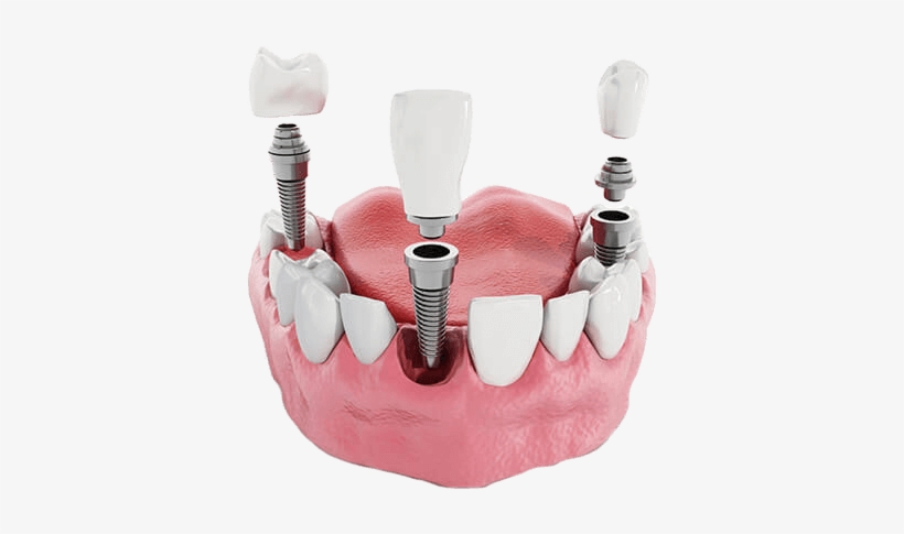 Port Jefferson Smiles Karen Halpern Dmd, Ms Dental - Impianto Dentale Straumann, transparent png #4414194