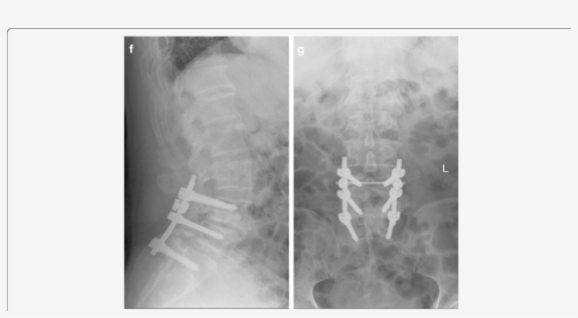 F, G Postoperative Lumbar Spine Showing L4-l5 Correction - Lumbar Vertebrae, transparent png #4432306
