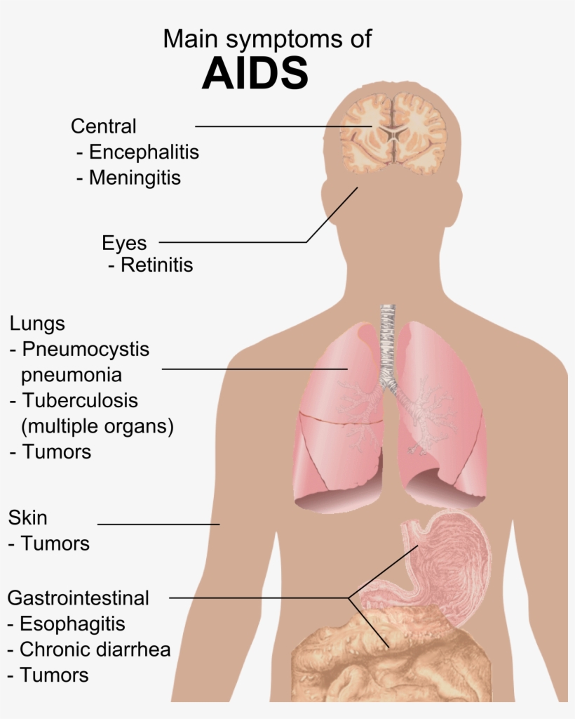 Symptoms Of Aids, transparent png #4492379