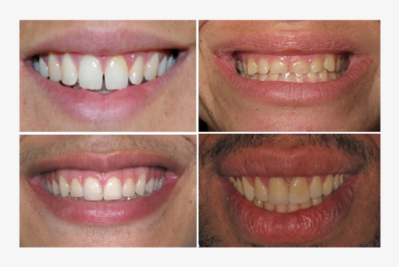 A Standardized Smiling Frontal Photograph Was Taken, transparent png #4530123