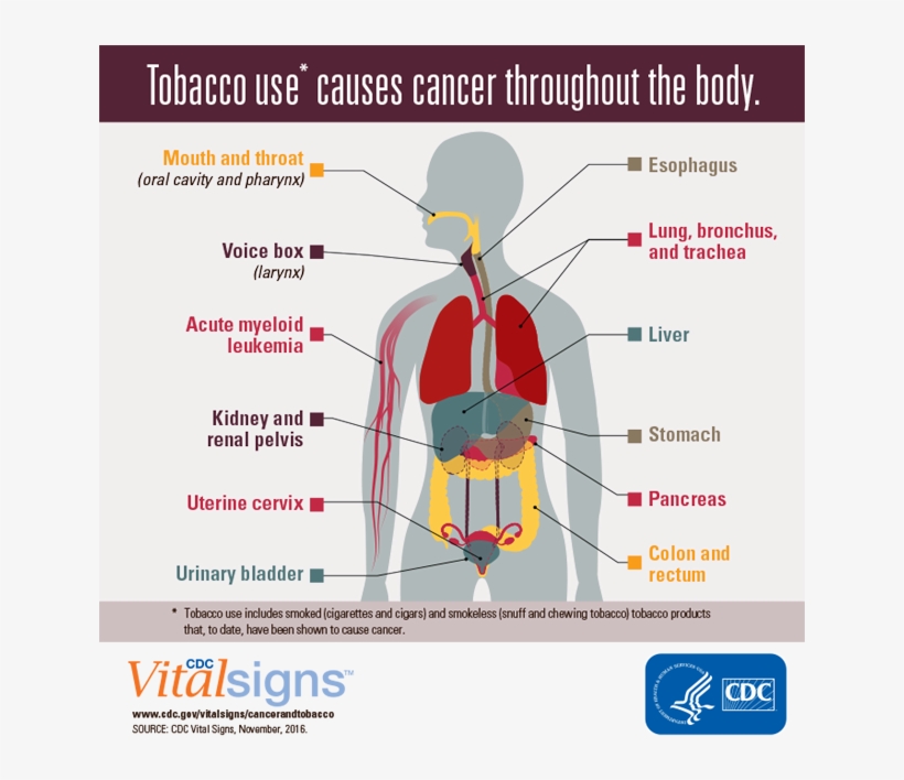 Cancer Caused By Tobacco Consumption, transparent png #4545995