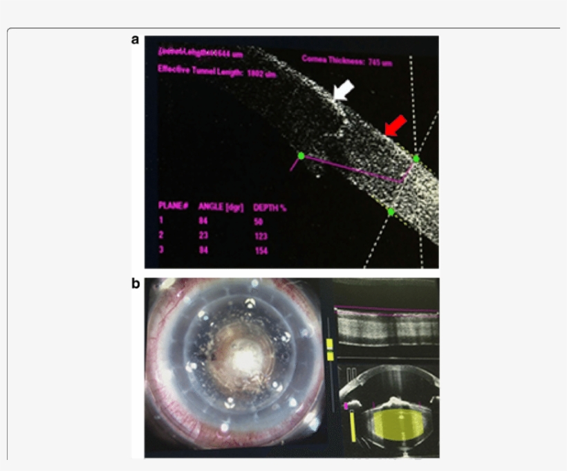 The White Arrow Indicates The Corneal Graft - Capsulotomy, transparent png #4561929