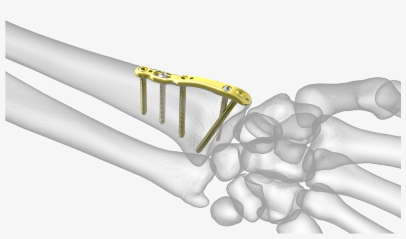Divergent Radial Styloid Plate - Radial Styloid Plate, transparent png #4632120
