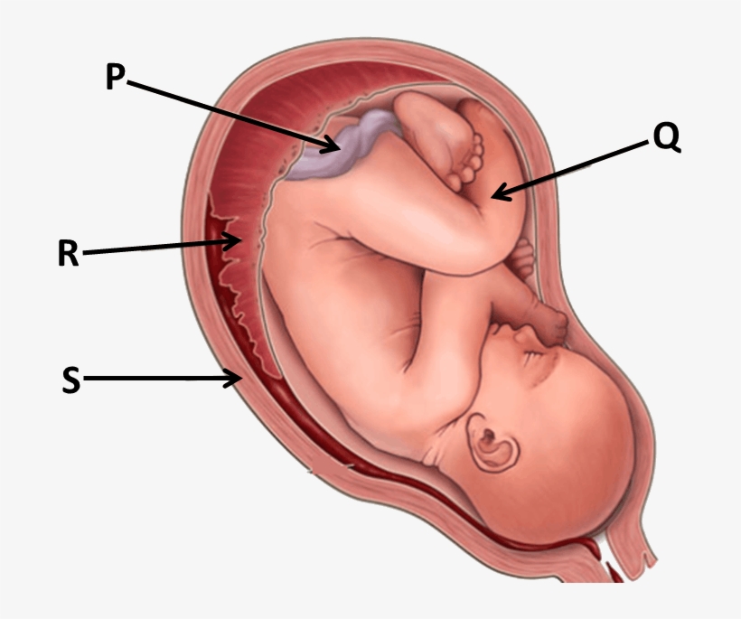 Image Showing Pregnancy - Placenta Previa, transparent png #4673290