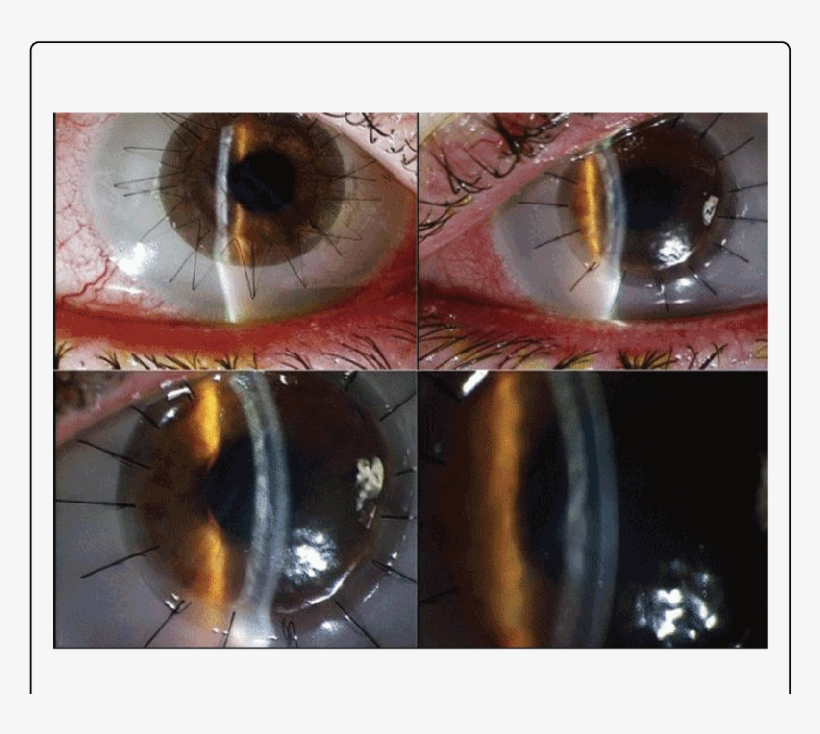 Post Dalk Images (sibling 1) Of Right And Left Corneas - Cornea, transparent png #4692659