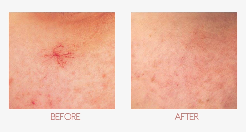 About - Facial Vein, transparent png #4728219