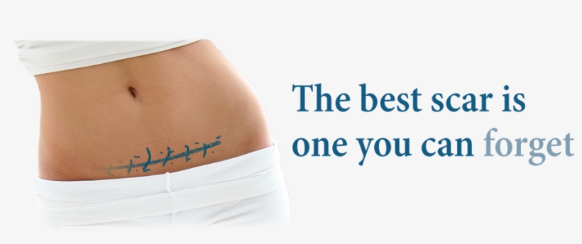 Here Are Some Of The Many Benefits - Kelo Cote Before And After Keloid, transparent png #4746395