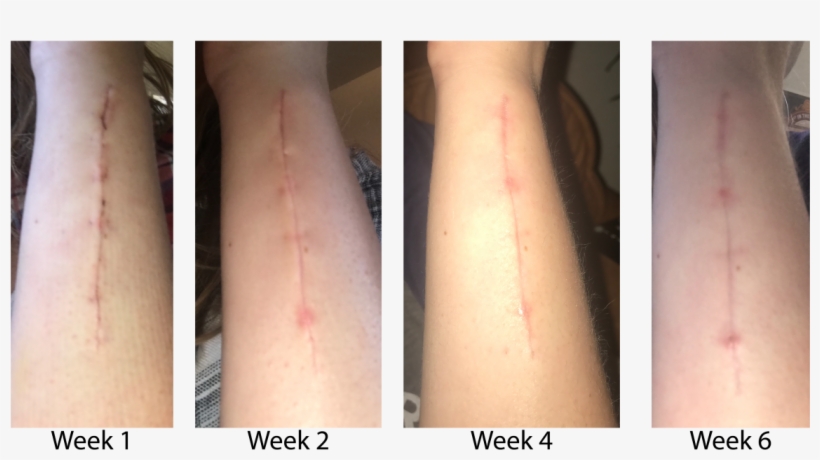 Mary's Cbc Compound Scar Progression - Scar Progression, transparent png #4746650
