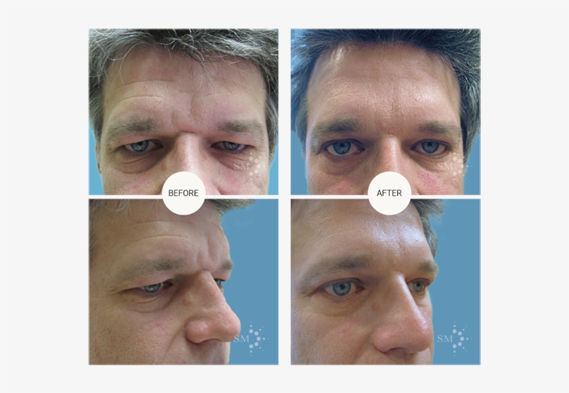 Forehead Lift - Montreal, transparent png #4789998