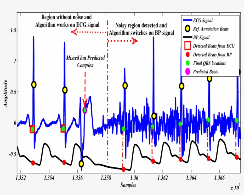 In Noisy Zones Of Ecg, Bp Signal Will Be Used For Heartbeat - Heartbeat Detection Algorithm, transparent png #4853503