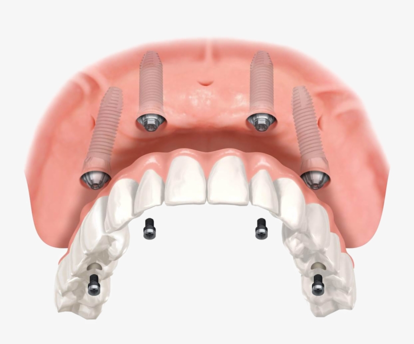 They Are Versatile Attachments Which Allow A Wide Variety - All On 4 Upper, transparent png #4854172