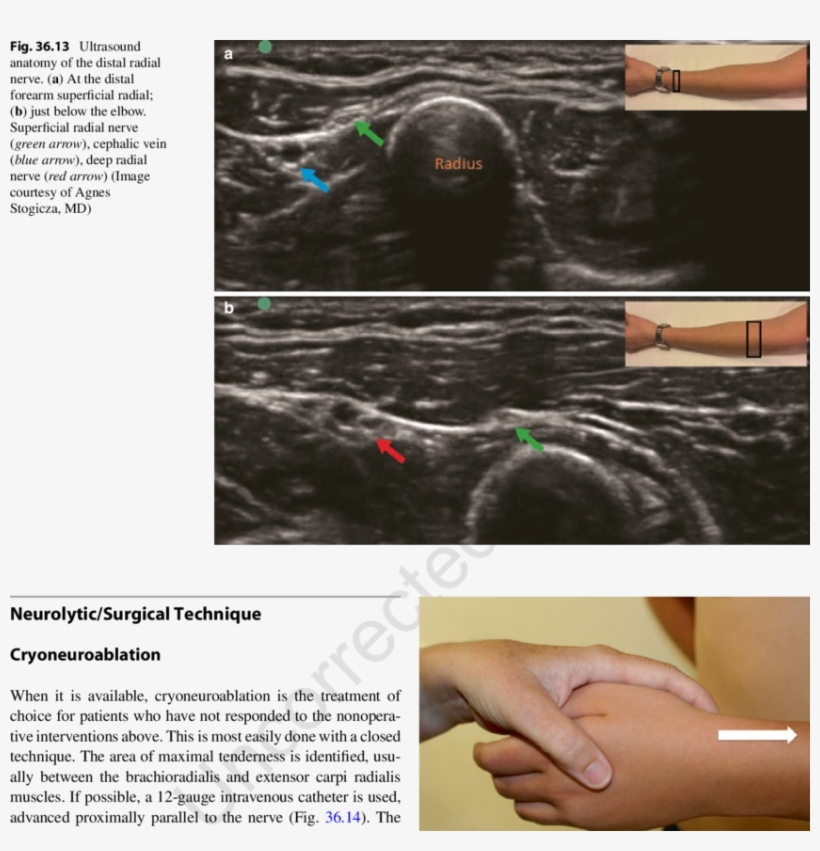 14 Direction Of The Cryoprobe For Cryoneuroablation - Superficial Radial Nerve Ultrasound, transparent png #4878765