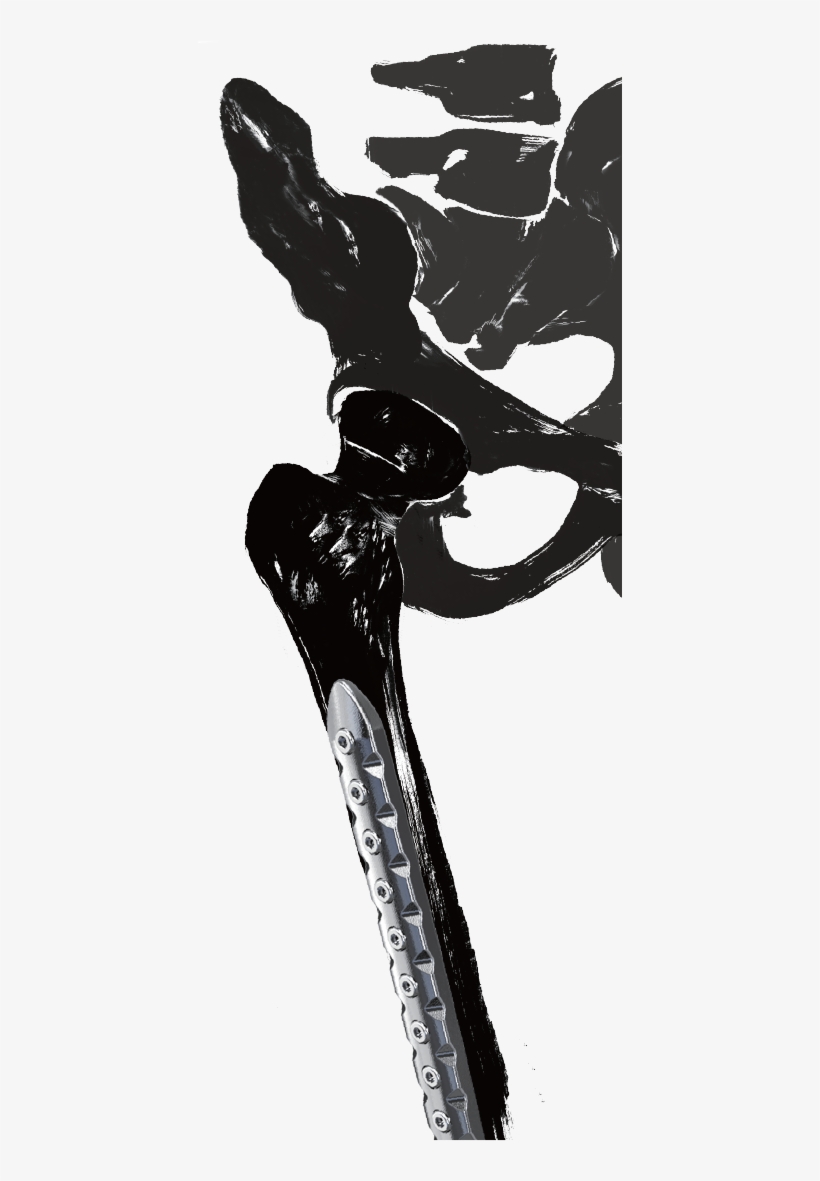 0mm Screw System In Femur A - Illustration, transparent png #4897325
