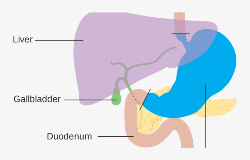 Facts About Stomach Cancer - Stomach Cancer, transparent png #4911410