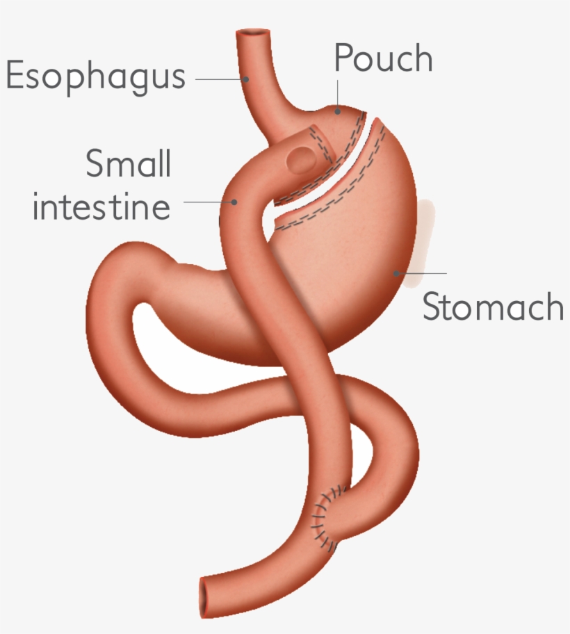 Laparoscopic Roux En Y Gastric Bypass, transparent png #4911883