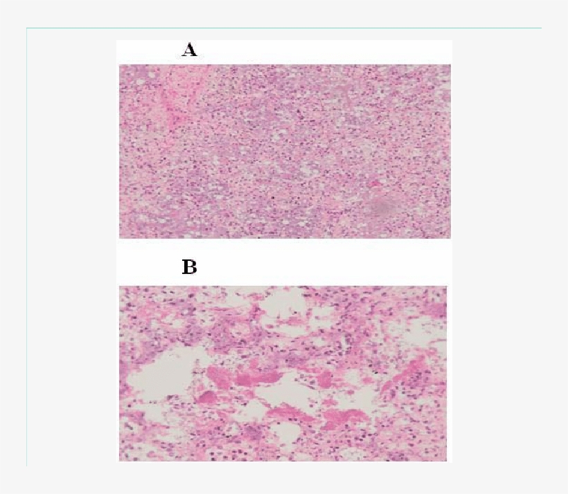 Histologic Assessment Of Post Mortem Lung Tissue - Staining, transparent png #4954047