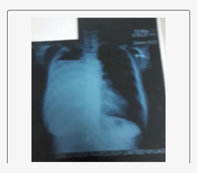 Chest X-ray At Presentation, transparent png #4990184