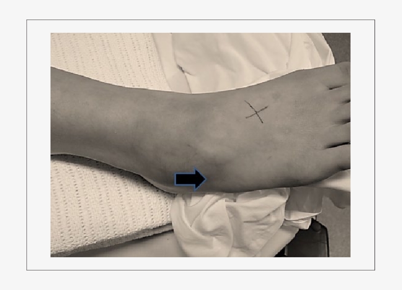 Arrow Pointer At Area Where There Is Tenderness And - Arrow, transparent png #4999647