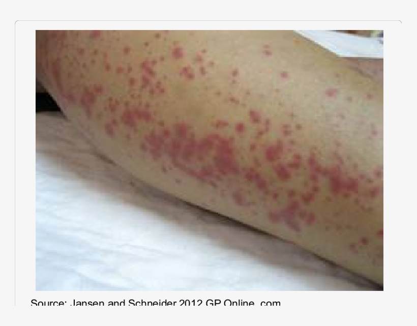 Skin Rashes - - Leptospirosis Skin Rash, transparent png #5008935