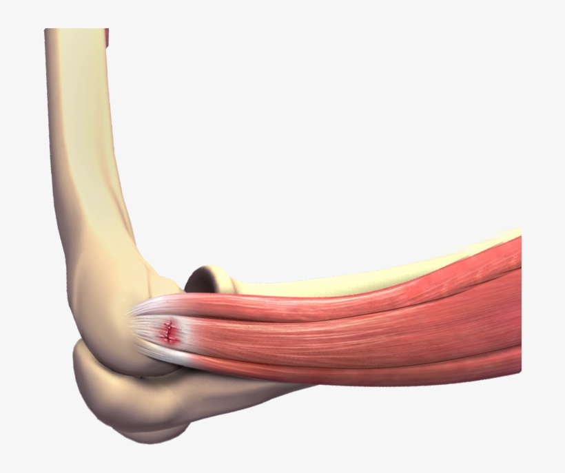 Tennis Elbow - Tennis Elbow Surgery, transparent png #5076964