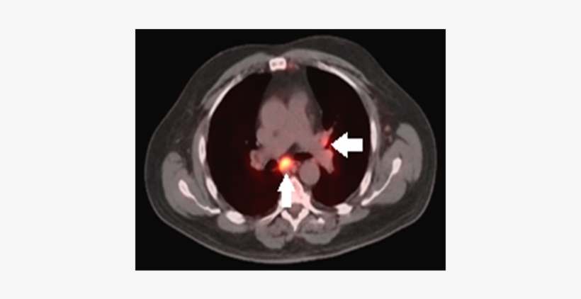 Pet/ct Of Head/thorax - Mediastinal Lymph Node, transparent png #5090223