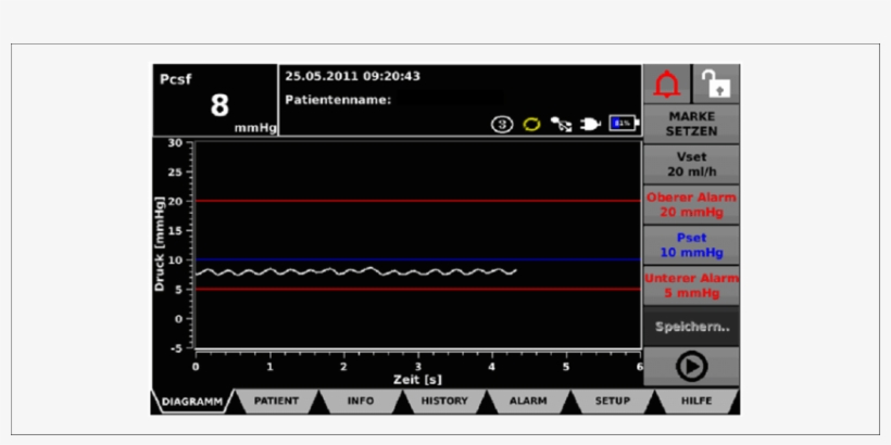 Liquoguard Monitor Demonstrating Current Cerebrospinal - Journal Of Endovascular Therapy, transparent png #5117238