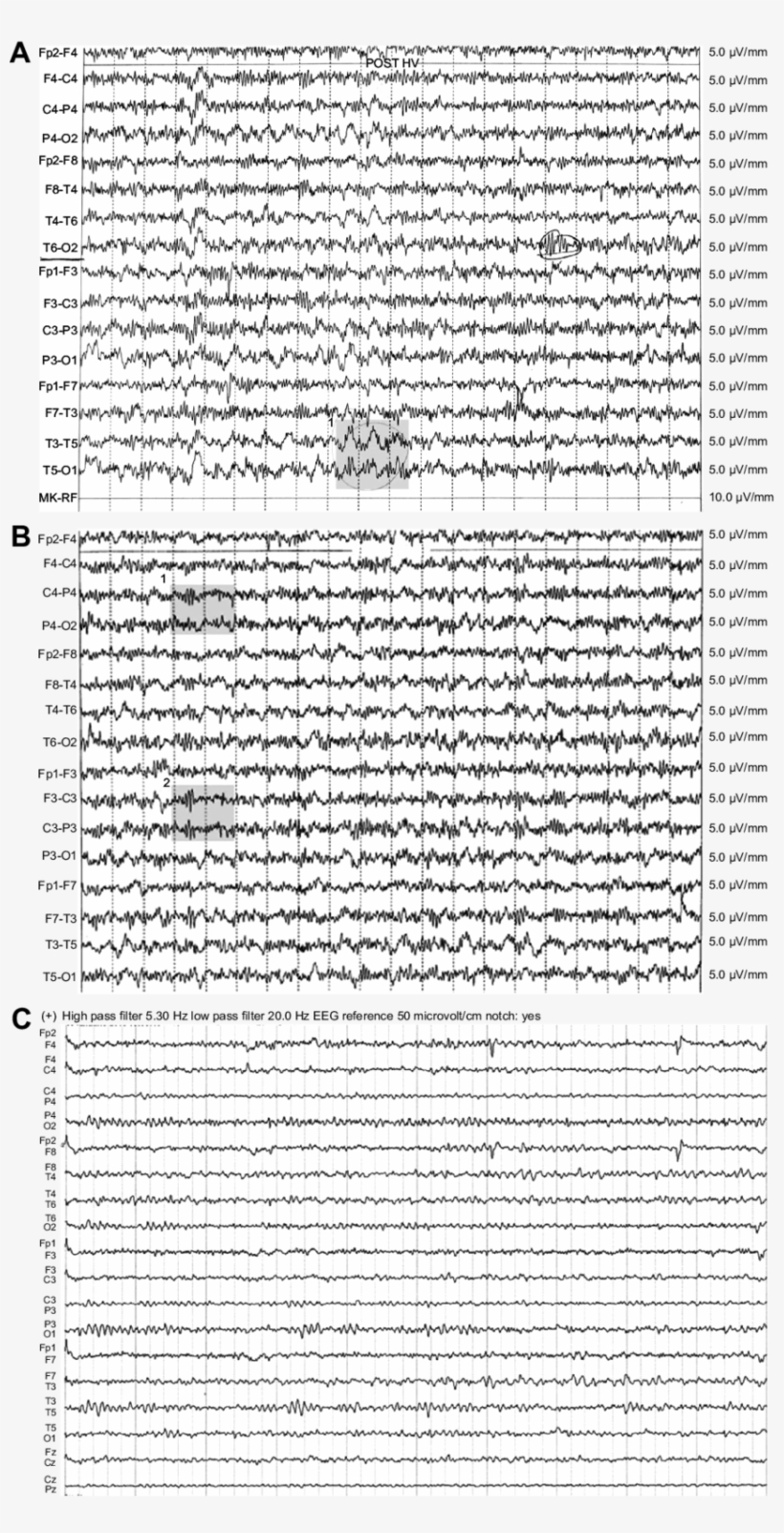 First Eeg Pattern Of The Patient - Delta Wave, transparent png #5152127