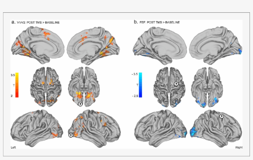 Distinct Effects Of Local Inhibitory Tms Over Early - Occipital Pole, transparent png #5215825