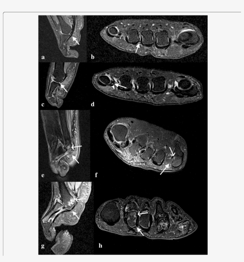 Intermediate Weighted, Fat Suppressed Sagittal And - Fat, transparent png #5231027